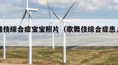歌舞伎综合症宝宝照片（歌舞伎综合症患儿寿命）